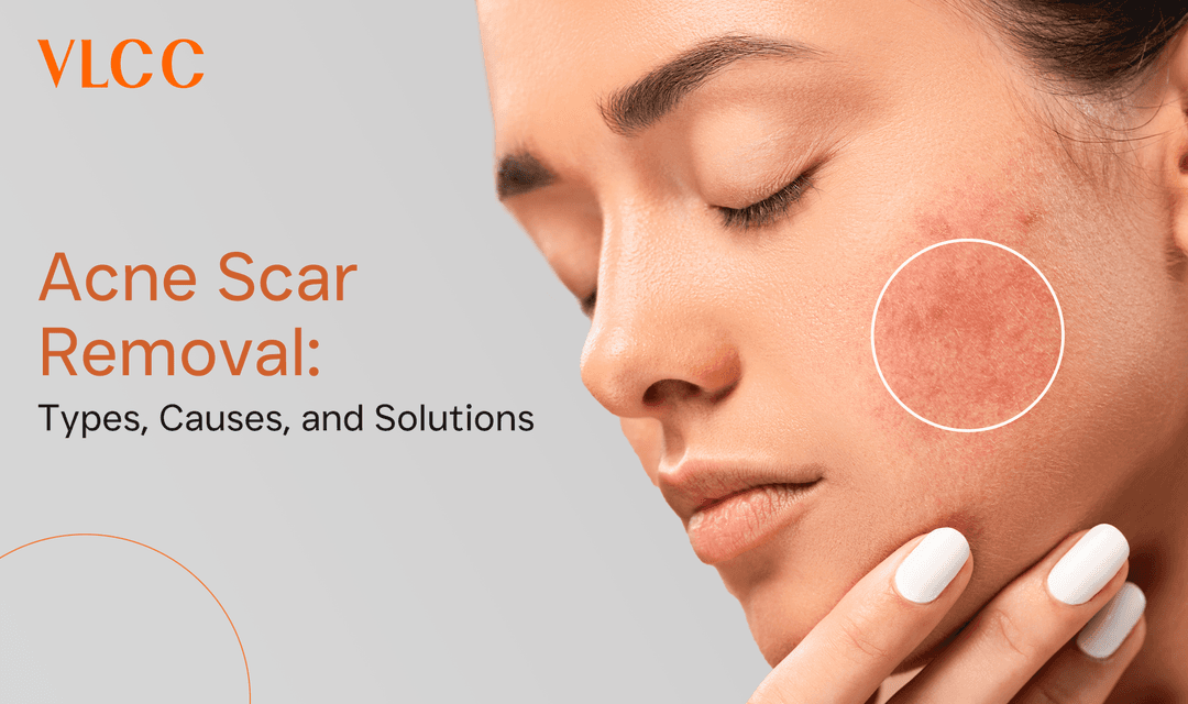 Say Goodbye to Acne Scars Your Ultimate Guide to Removal Techniques