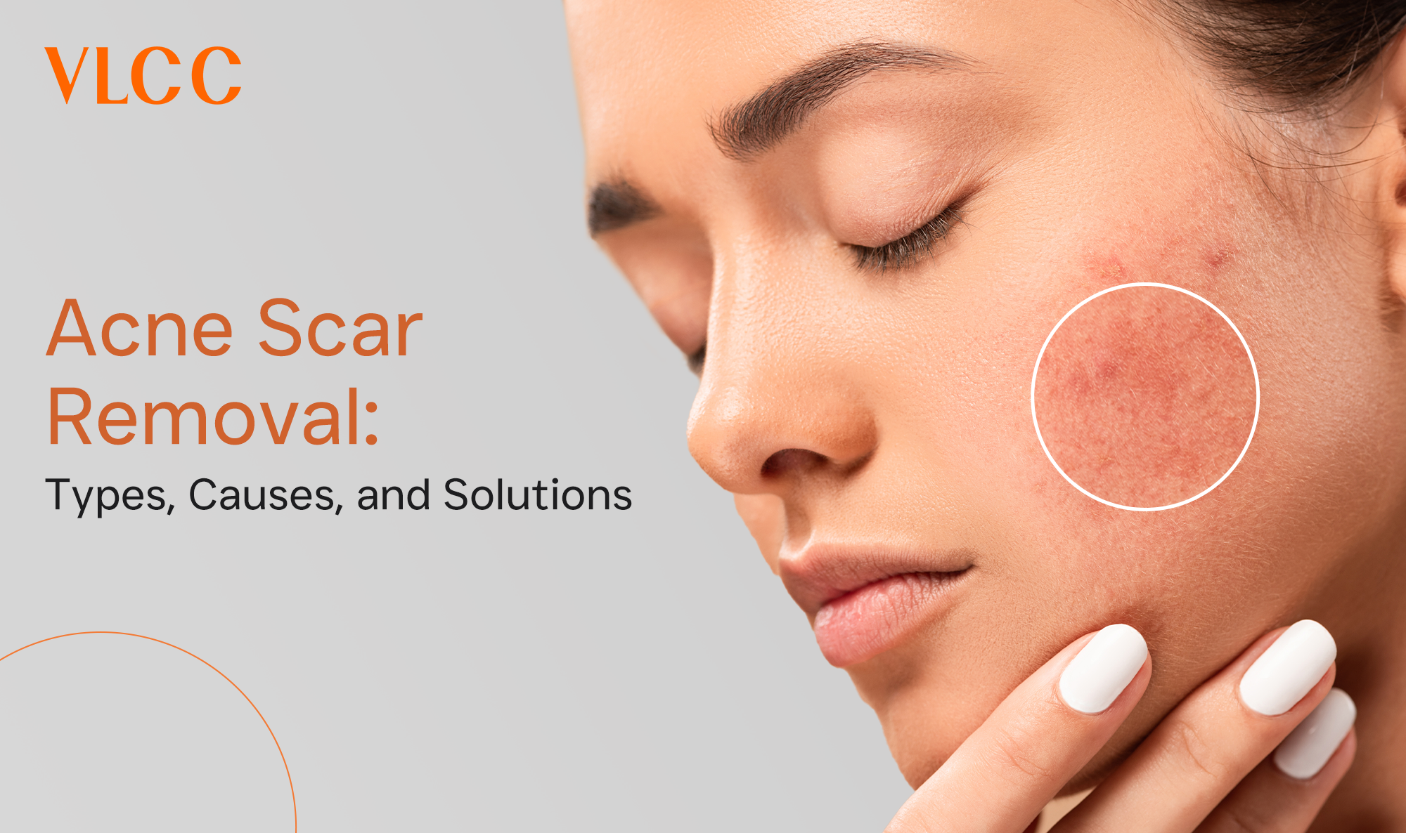 comprehensive guide to acne scar removal