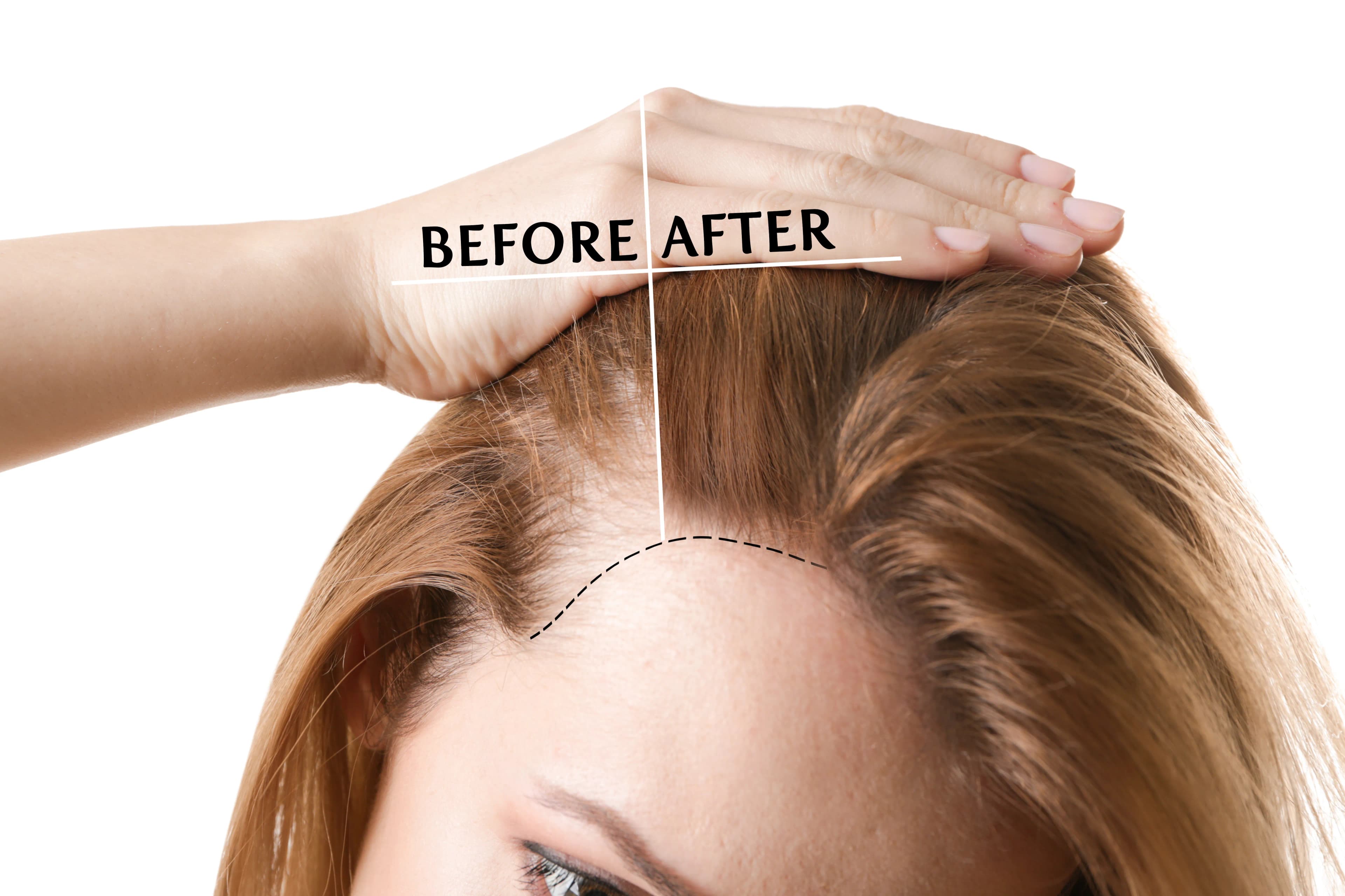 Hair Loss Treatments Compared for Success Rates