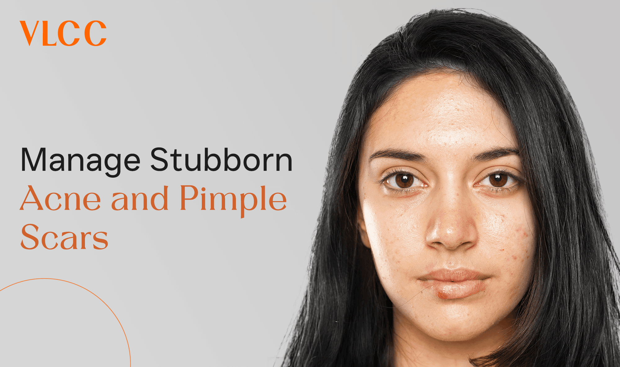 stubborn-acne-and-pimple-scars