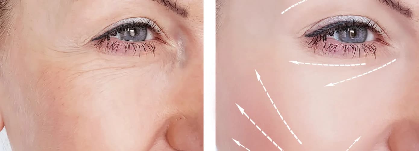 How-to-remove-wrinkles-from-face-quickly