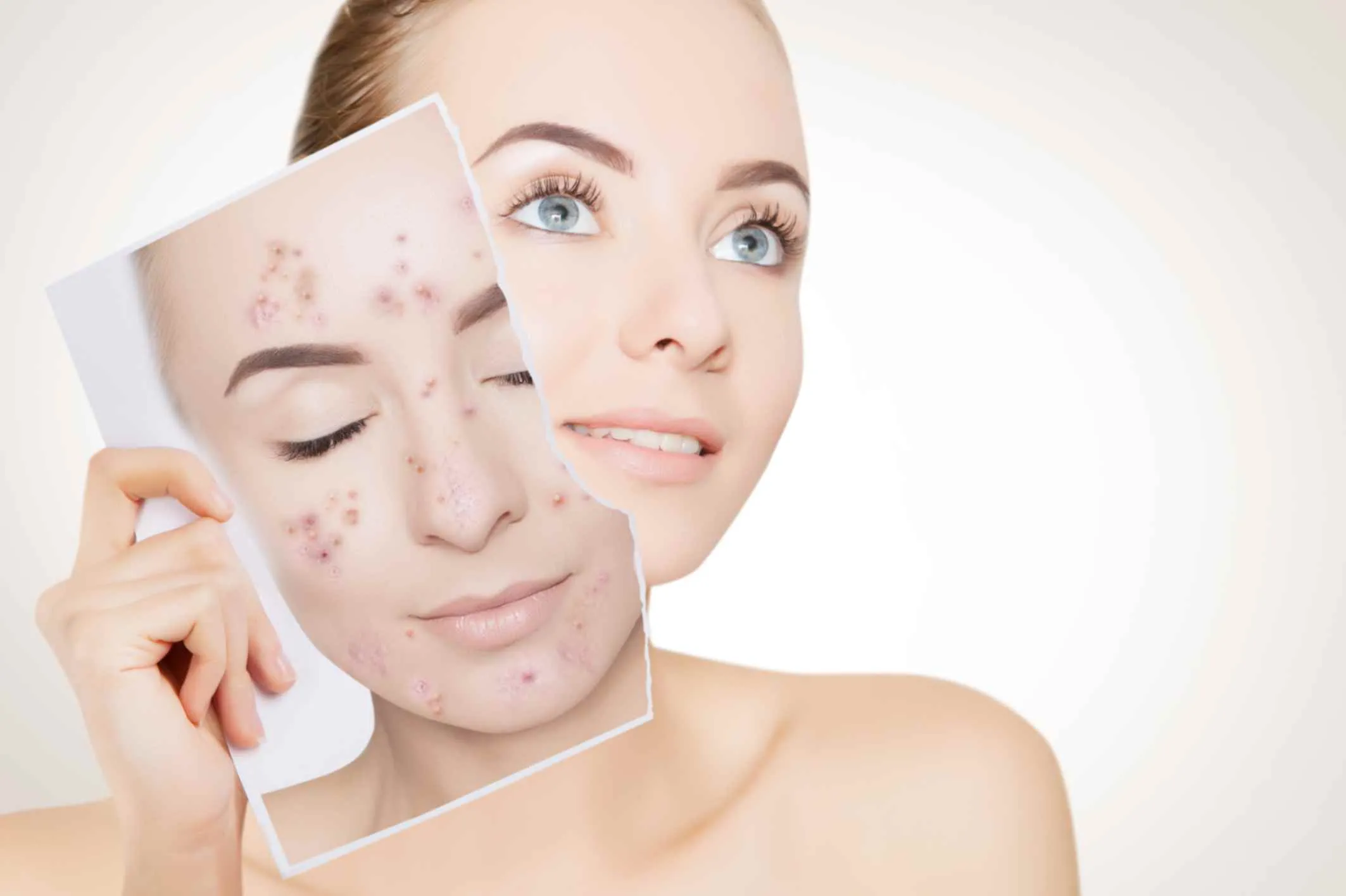 Skin treatments for acne and pigmentation