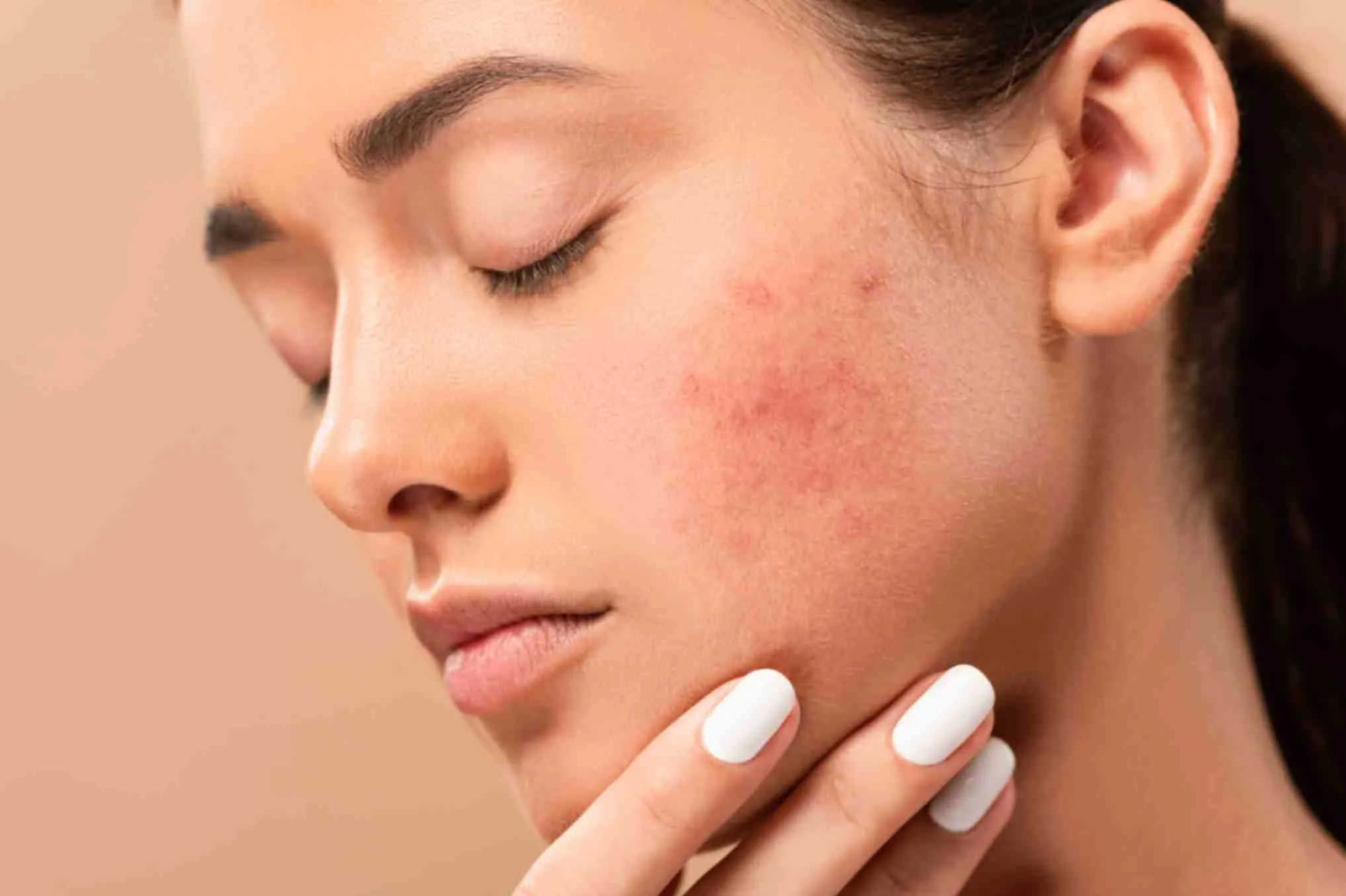 affordable acne and pimples treatment in India