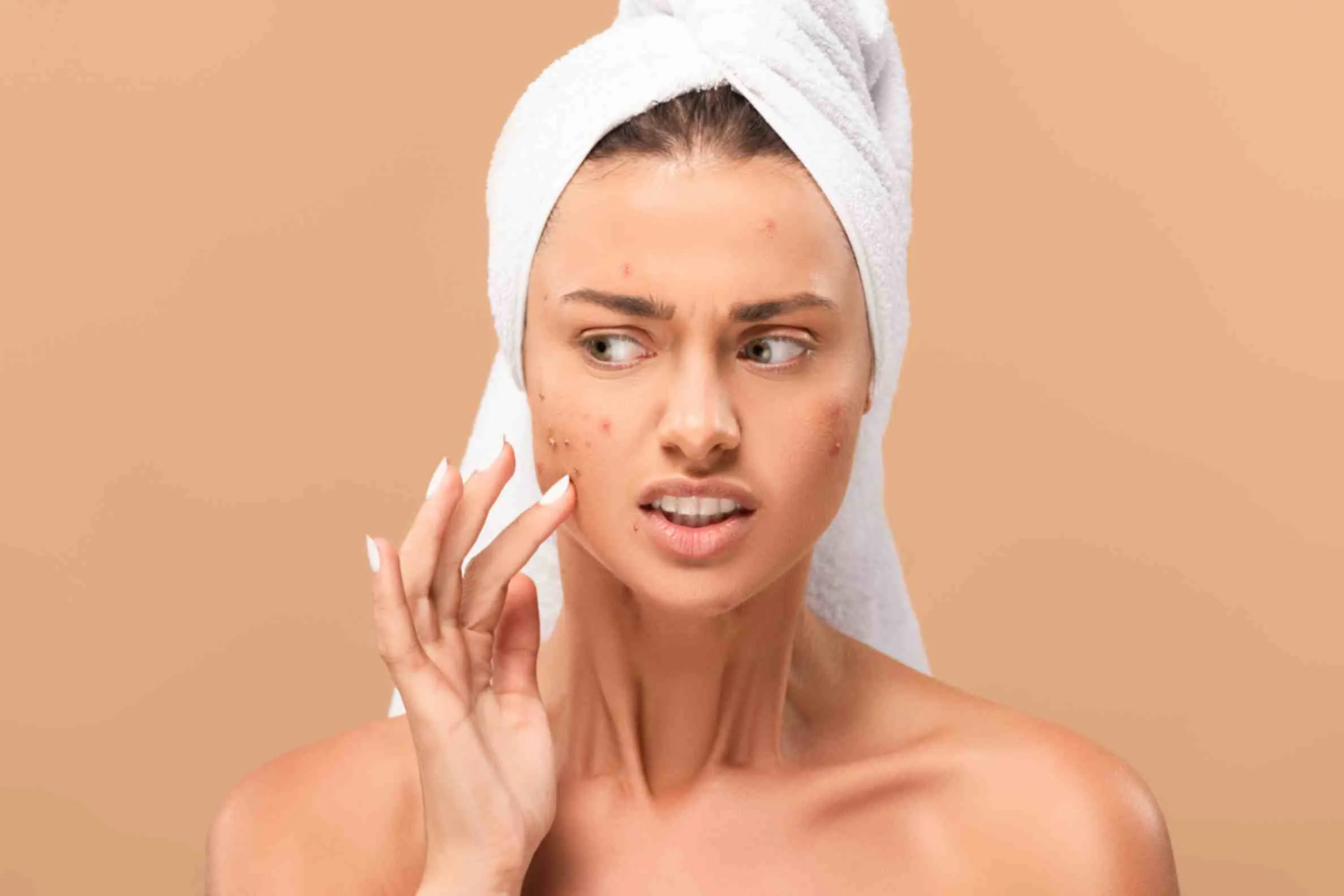 acne scars removal treatment in Delhi