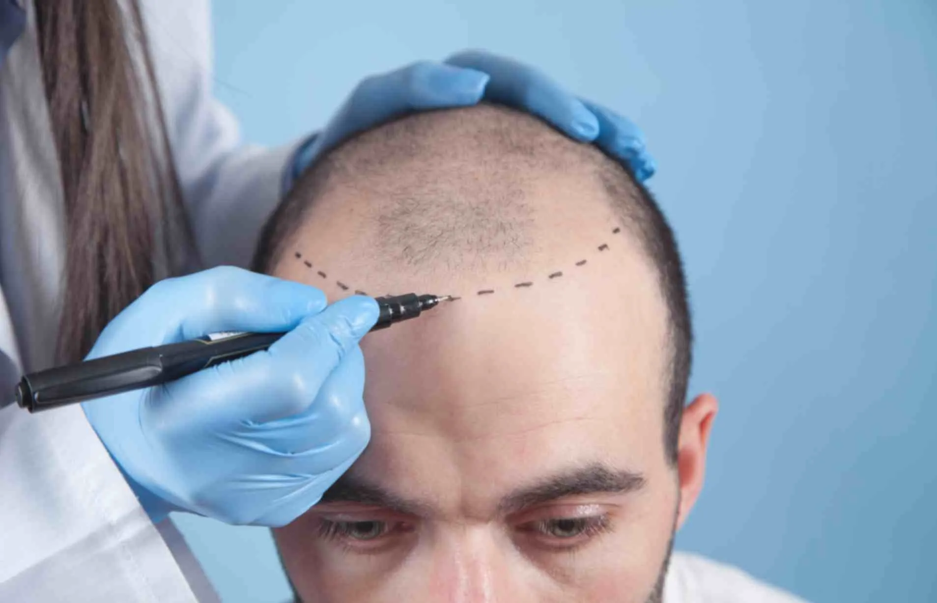 VLCC Hair Transplant