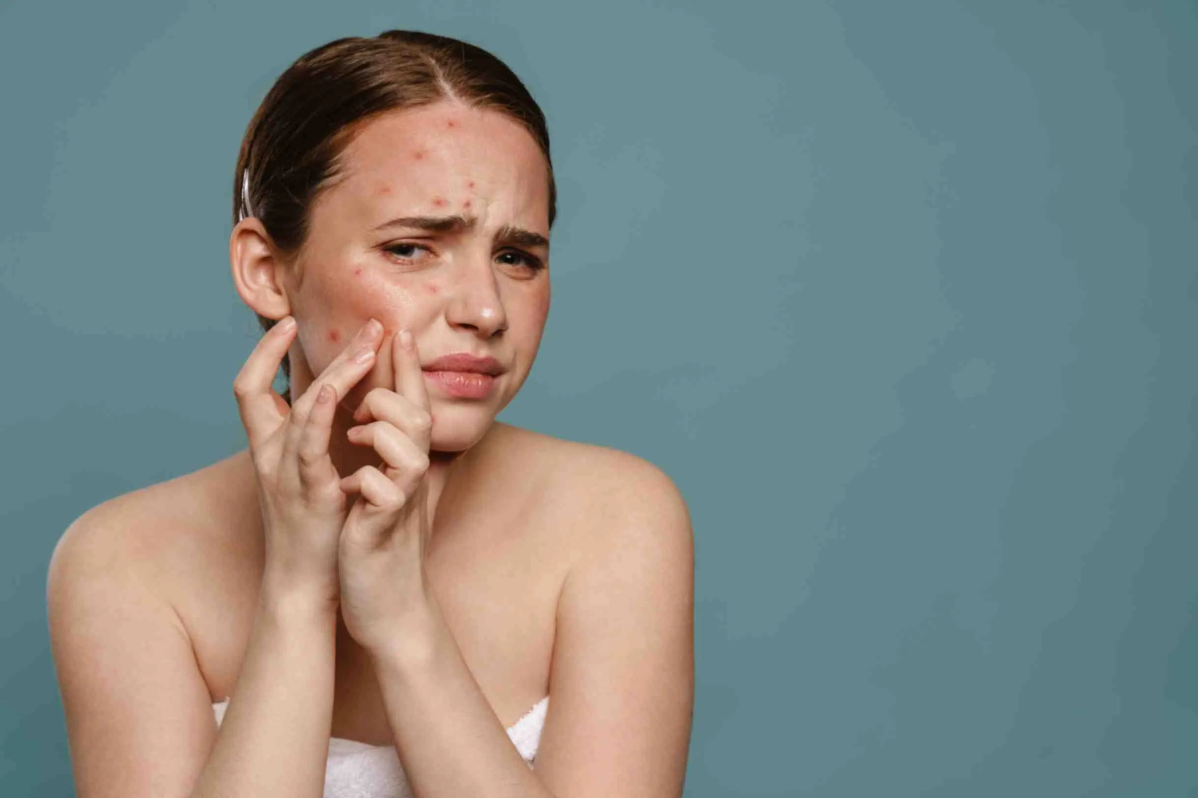 Effective acne treatments for a clear skin