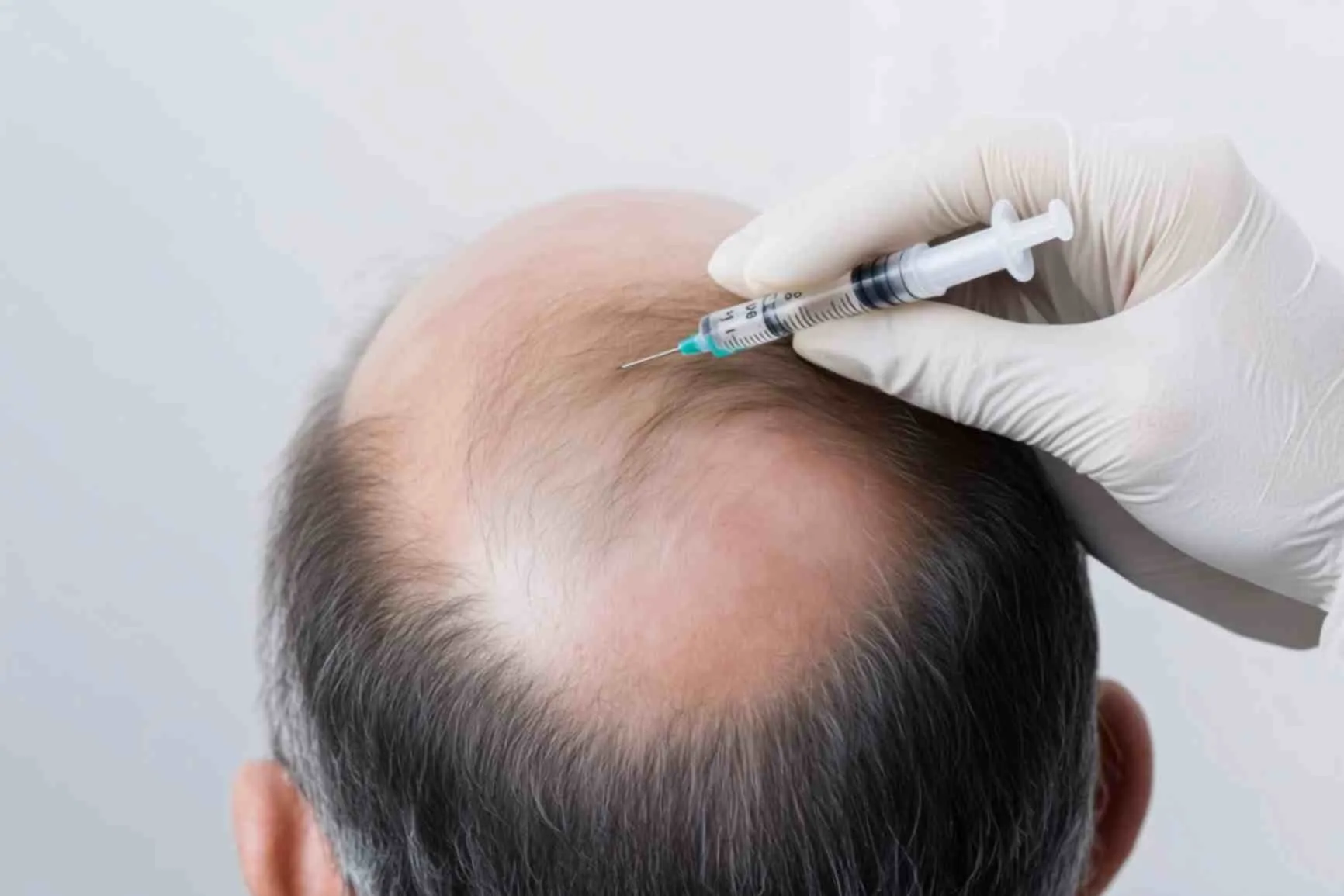 Hair Loss Treatment for Men in India