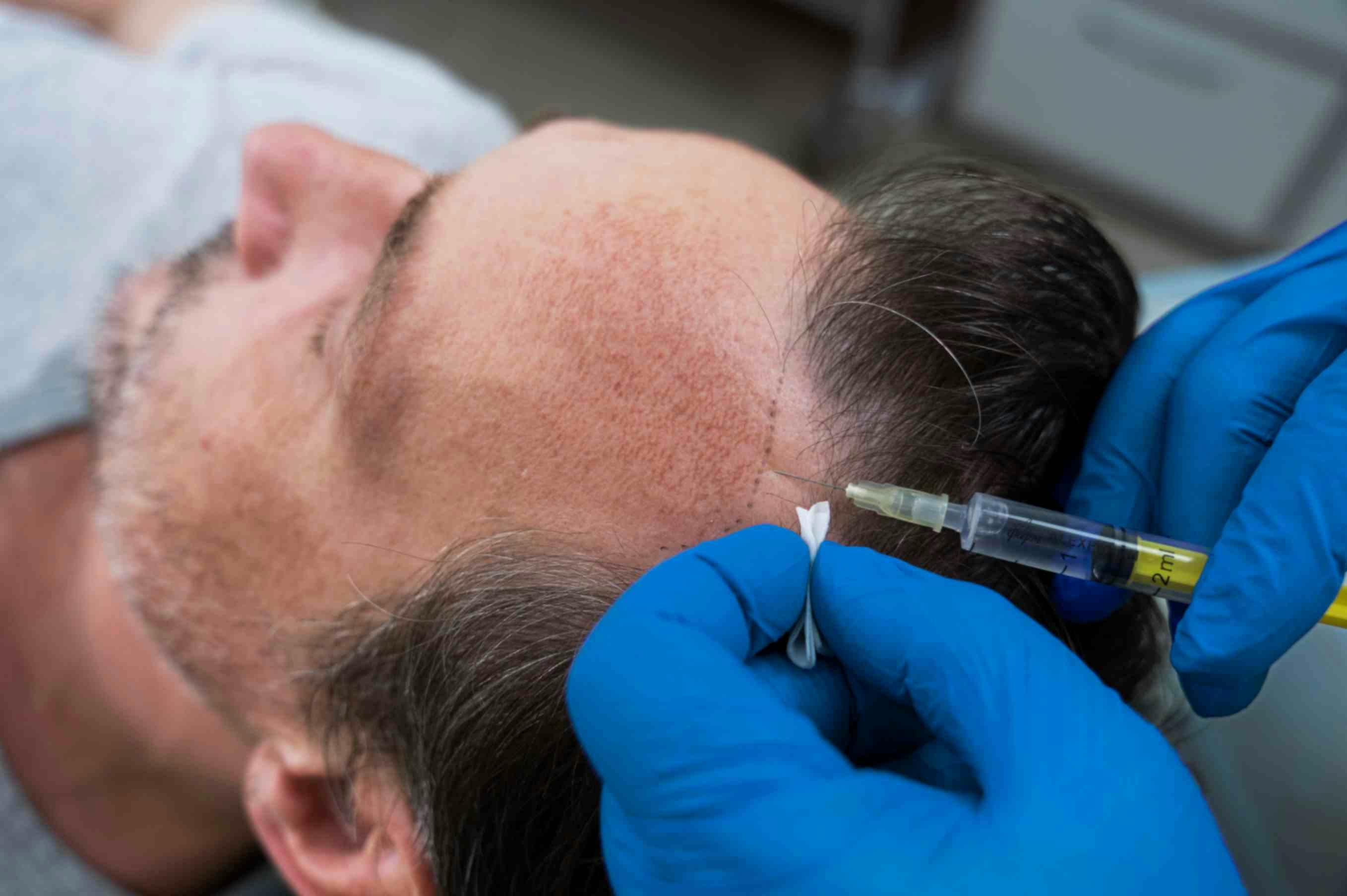 prp-permanent-or-one-time-solution-for-hair-loss
