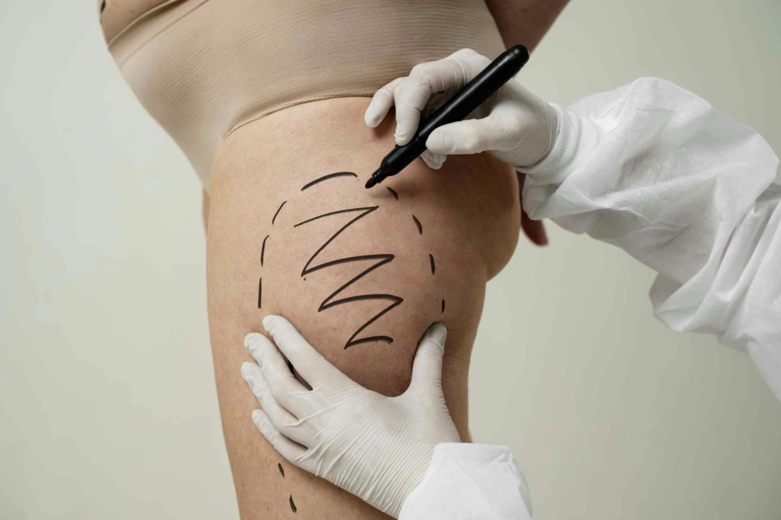 coolsculpting-for-nonsurgical-fat-reduction