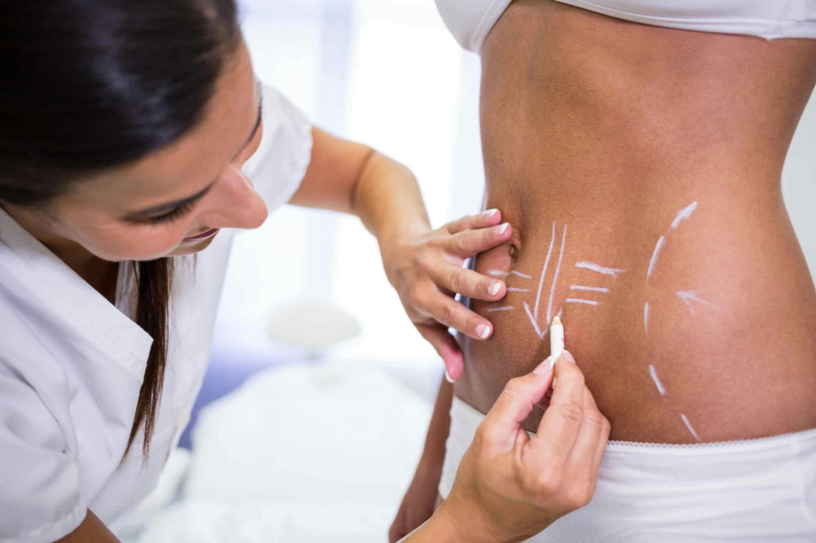 need-to-know-about-coolsculpting