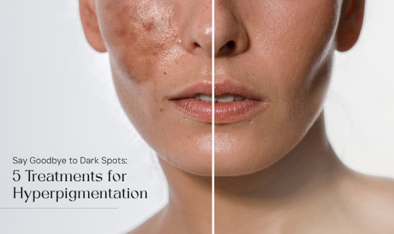 combat-hyperpigmentation-treatment-options