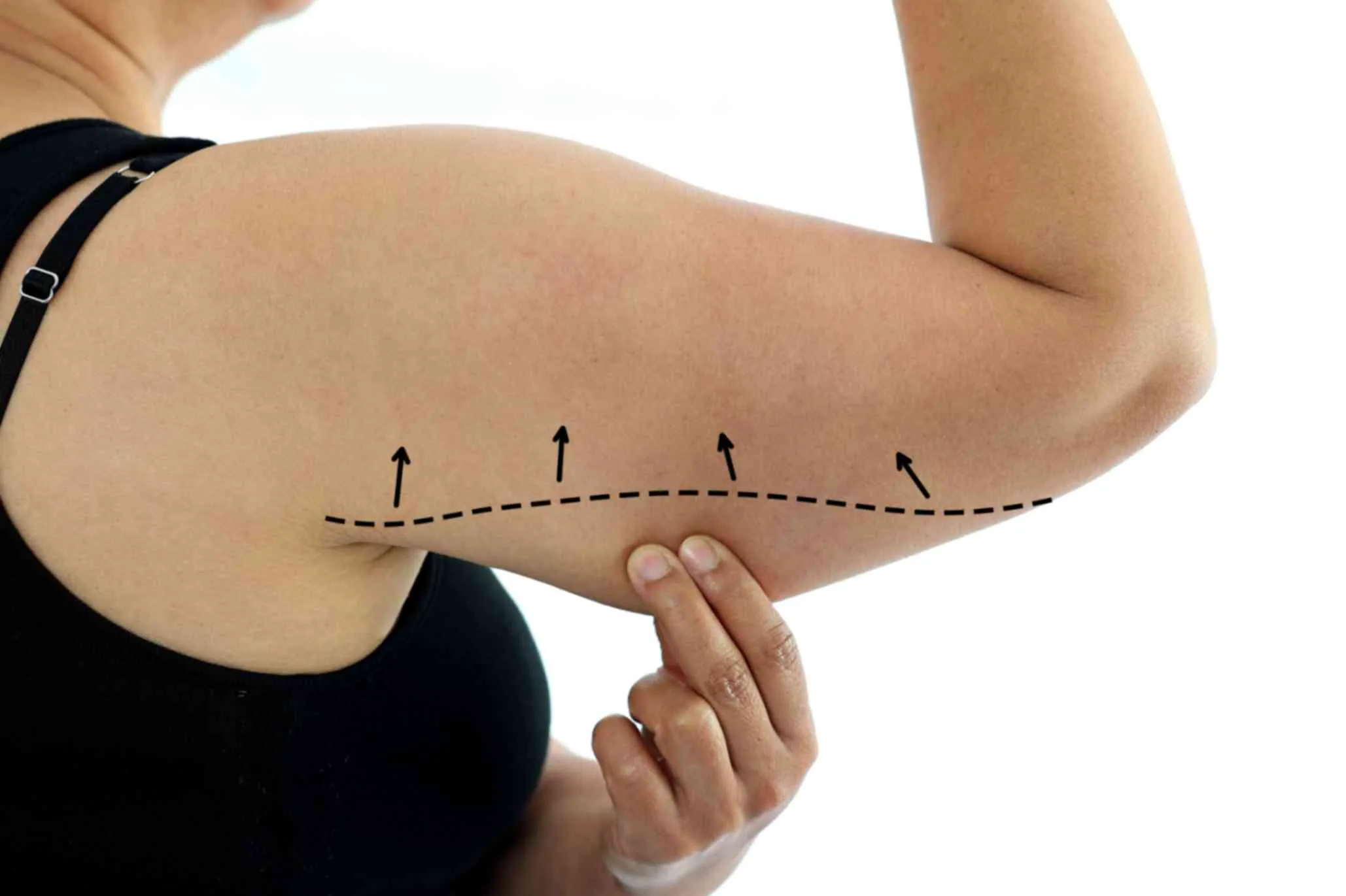 Upper Arm Fat Reduction