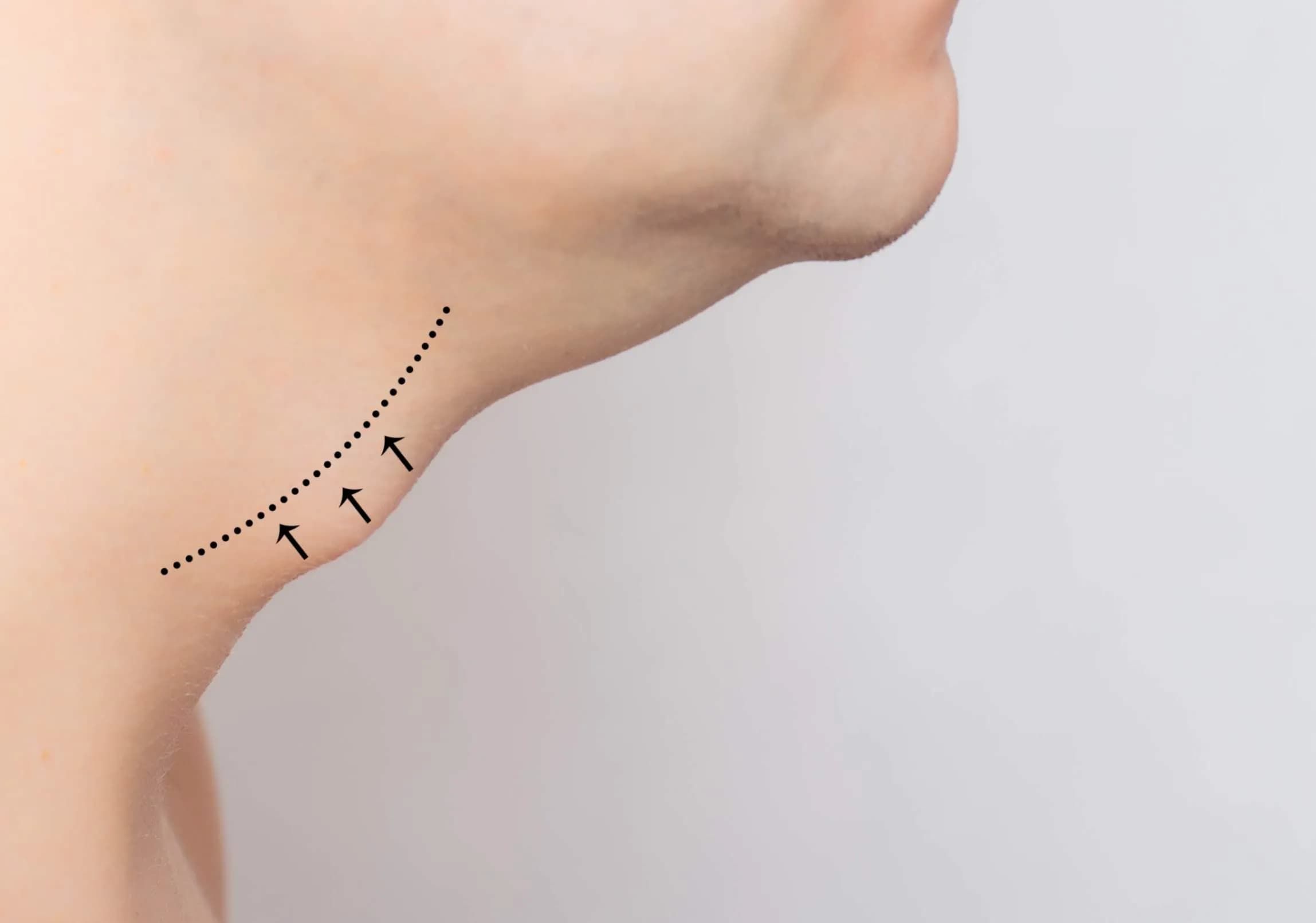 non-invasive neck fat reduction in India