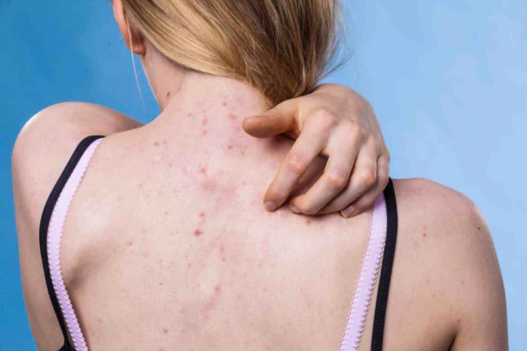 Chemical Peel