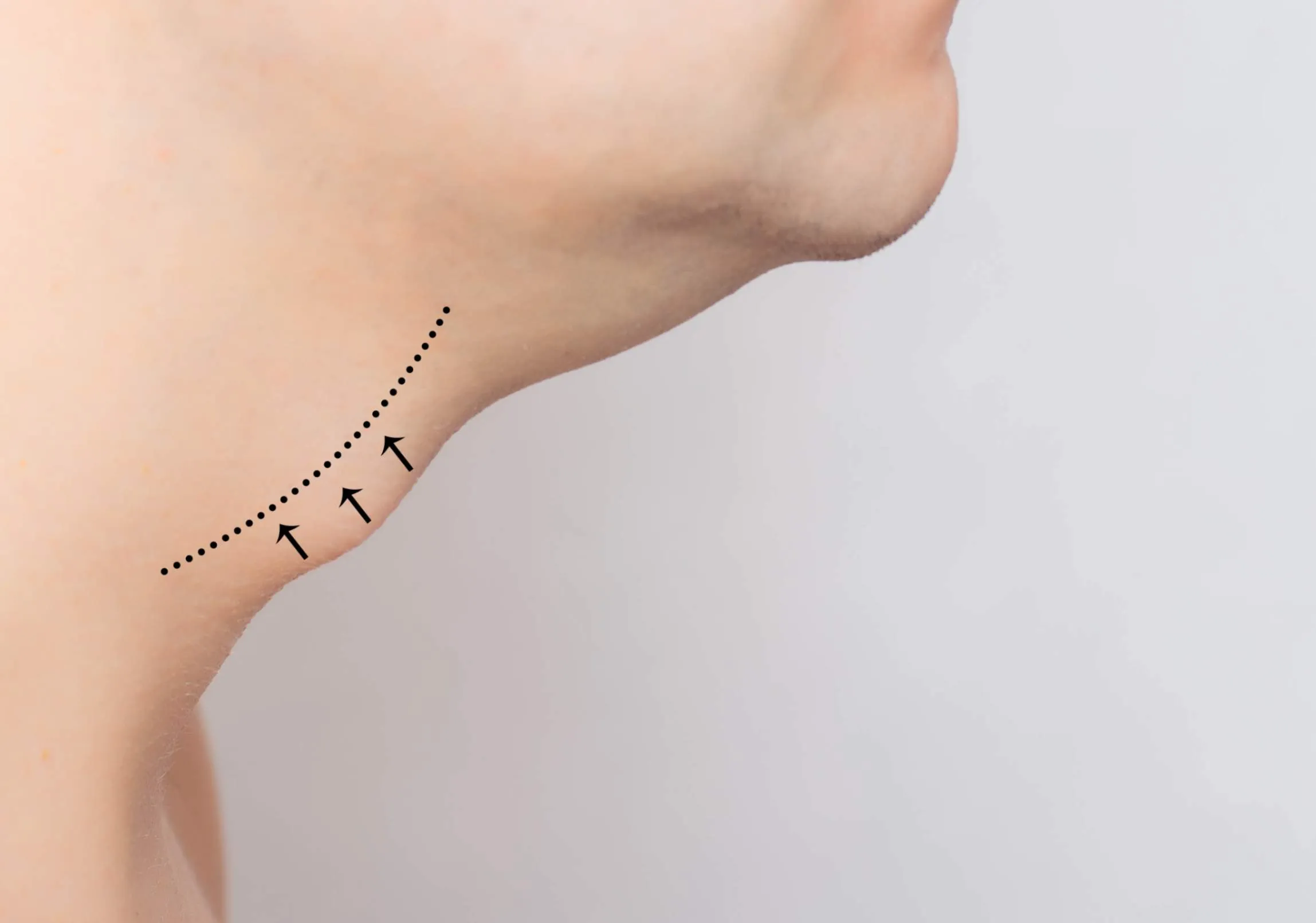 V-Fit Treatment