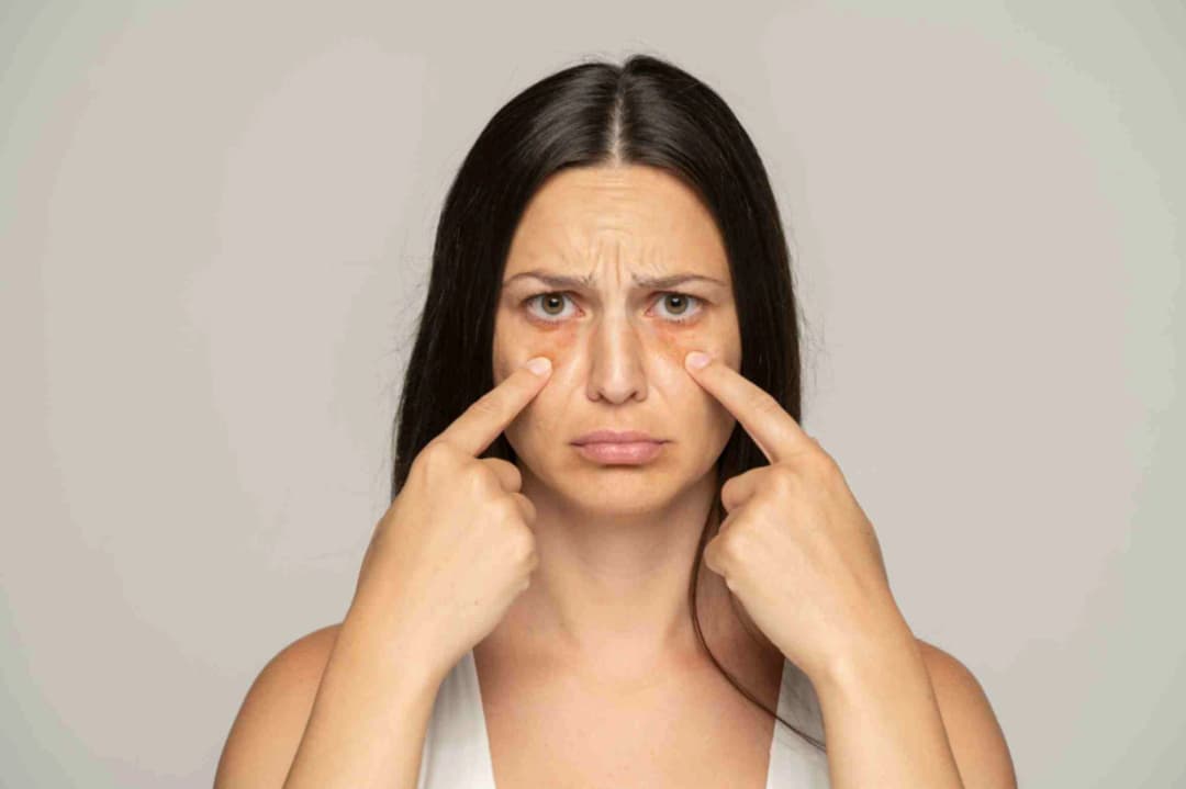 Chemical Peel