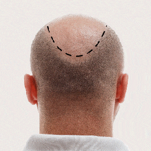 Natural Results Using Your Own Hair