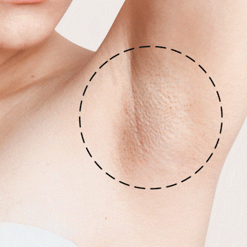 No More Ingrown Hair