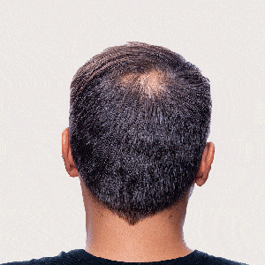 Tackle Bald Patches