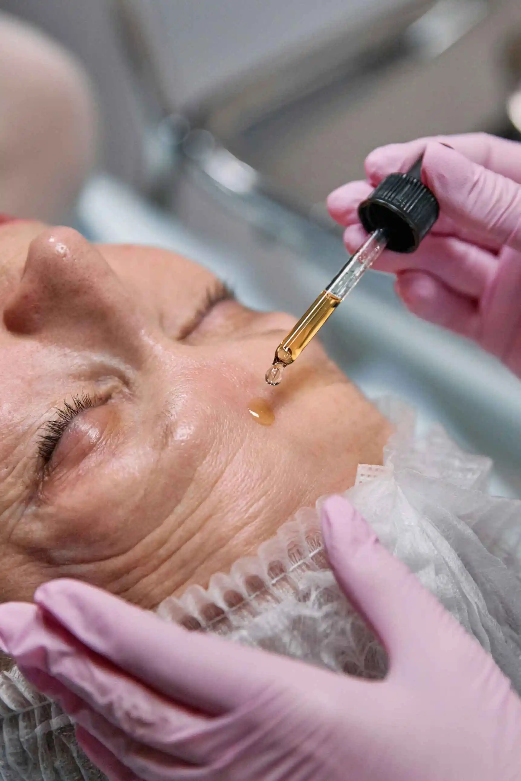 Chemical Peel