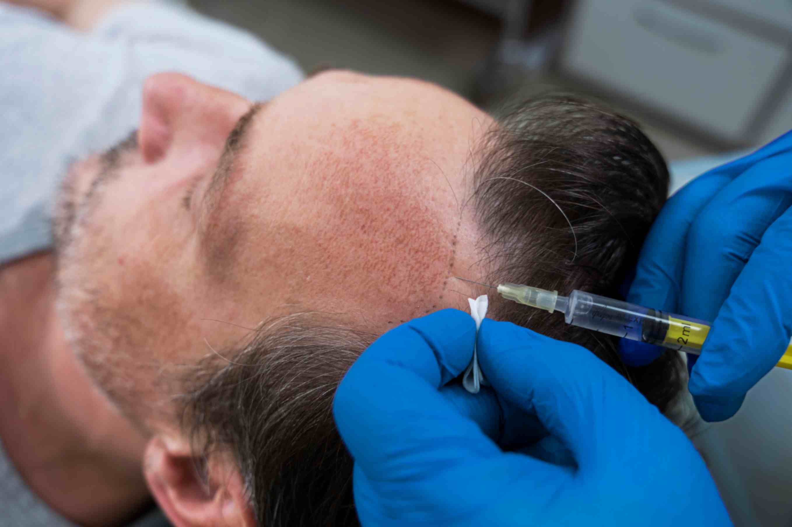 see-hair-transplantnt-results