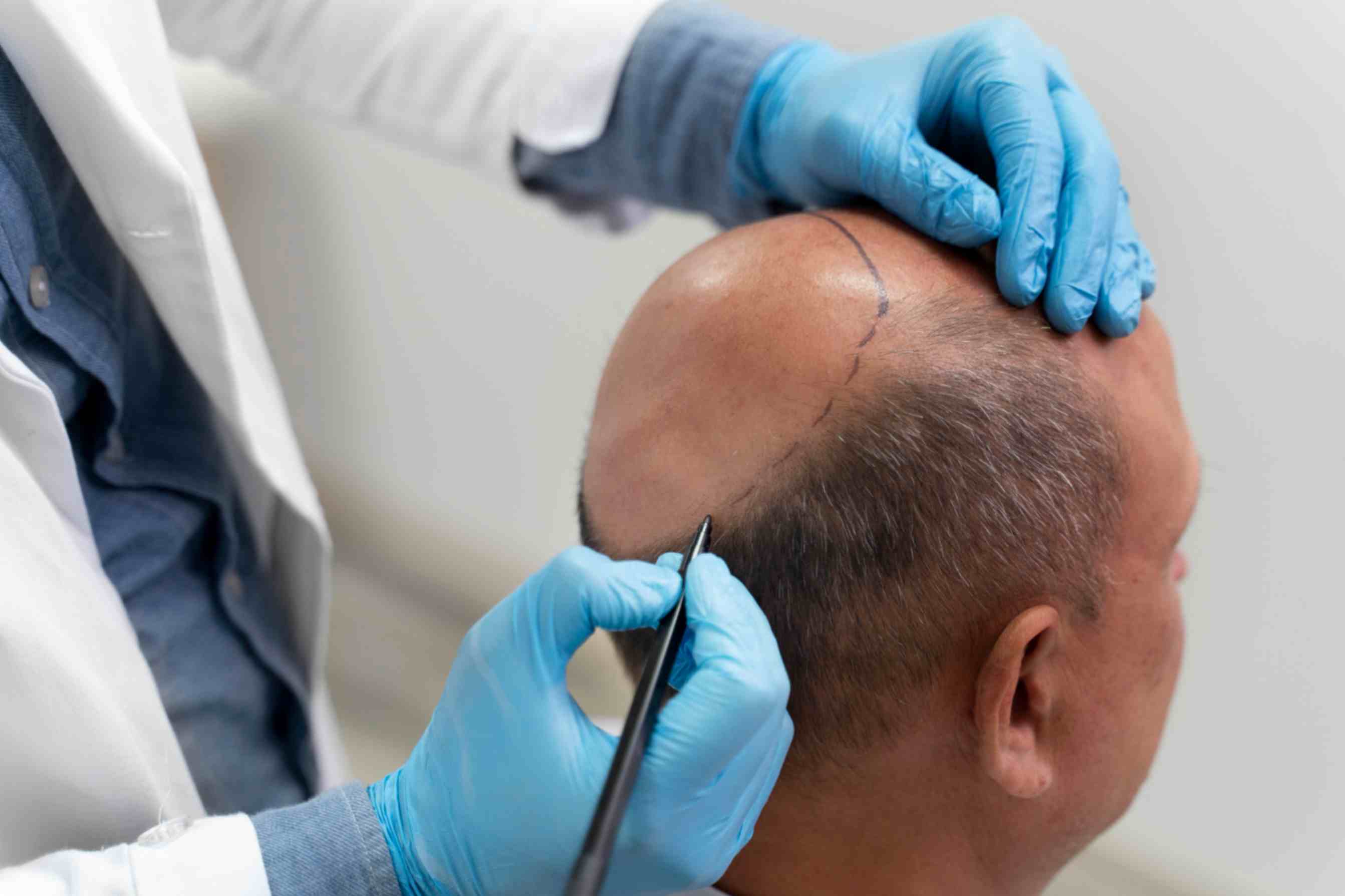 hair-transplant-natural-results-are-also-permanent