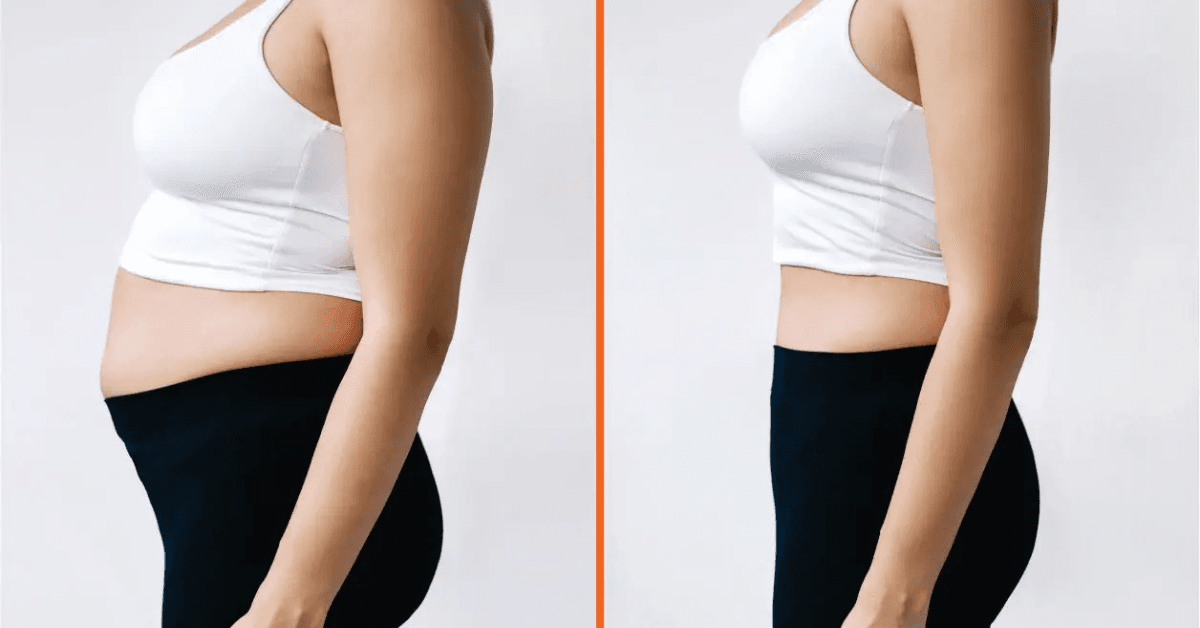 Tummy Tuck in Abu Dhabi: Cost, Benefits, and More